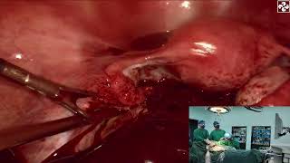 腹腔镜下卵巢黄体囊肿破裂修补术（Laparoscopic repair of ruptured corpus luteum of ovary）