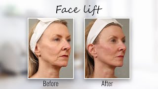 How to Get a Quick Face-Lift Without  Any Surgery #CAVITATION #FACELIFT #SKINTIGHTENING