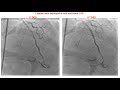 case 72 pci manual postpartum myocardial infarction