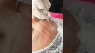 Hyalnano Filling ZENA | Anti Wrinkle Treatment