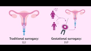 Difference between traditional surrogacy and gestational surrogacy #upsc