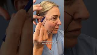Dr. Daniel Schneider Performs Surgical Markings for a Facelift & Neck Lift