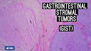 Gastrointestinal Stromal Tumours (GIST)