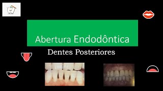 Abertura endodôntica de posteriores | Resumos de Odonto