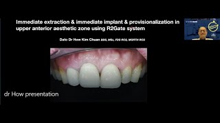 R2Gate with immediate extraction \u0026 immediate implant \u0026 provisionalisation in upper anterior ...