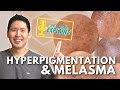 Dermatologist Explains: Hyperpigmentation and Melasma - How to Manage it with Top Picks