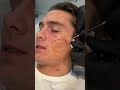 atrophic acne scar treatment with dr. qazi acnescarremoval