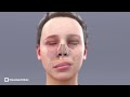 facial paralysis treatment cleveland clinic