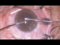 Aqueous miss direction,  cataract in angle closure glaucoma eye Mishev Live Stream