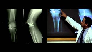Introduction to Hip and Knee Replacement- Lecture, Dr. Nitin Goyal