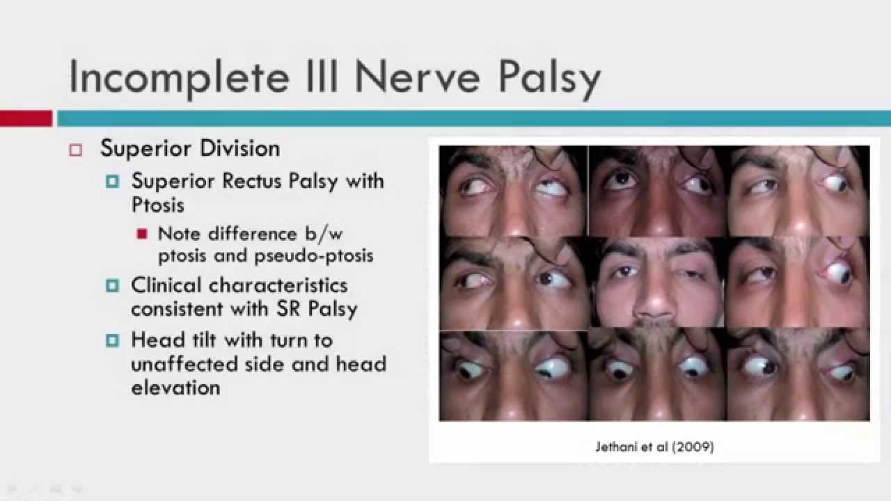 Cranial Nerve Palsy Causes Cranial Nerve Palsy Causes
