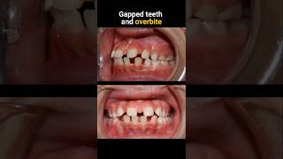 Braces for gapped teeth and overbite #braces #orthodontist #bracesoff #dentist