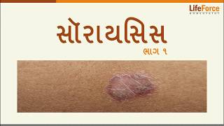 What should you know about Psoriasis  treatment Gujarati- Part 1/5