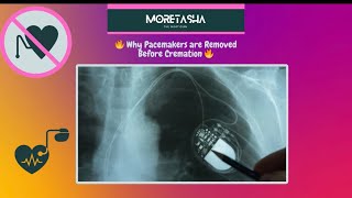 🔥 Why Pacemakers are Removed Before Cremation 🔥