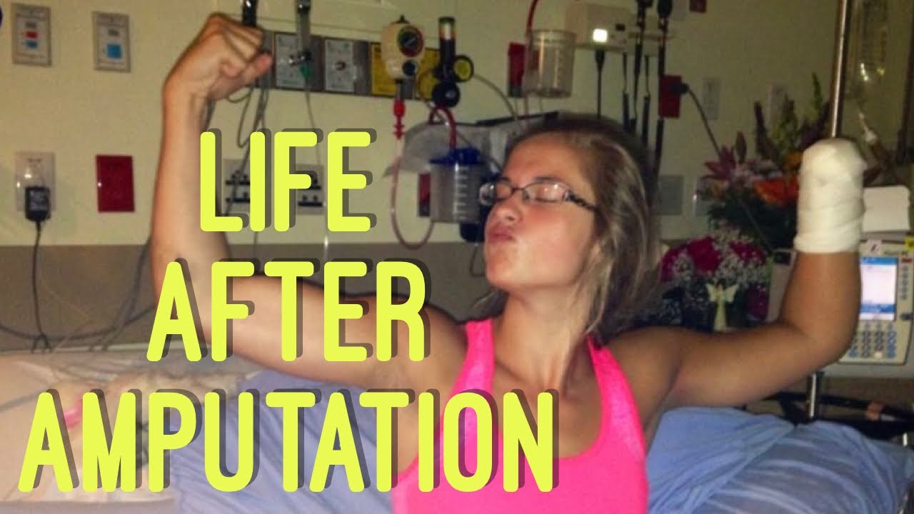 HOW I SURVIVED MY AMPUTATION RECOVERY - YouTube