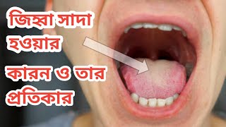 জিহ্বা সাদা হওয়ার কারণ ও তার প্রতিকার ! The reason the tongue is white and they remedy!