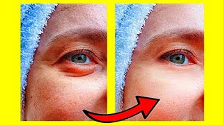 4 Remedios Caseros Para Eliminar Ojeras Y Bolsas Bajo Los Ojos