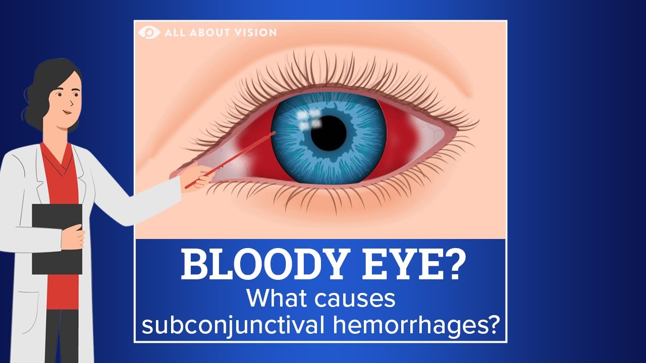 Subconjunctival Hemorrhage (Blood In Eye) - YouTube