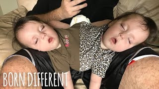 Conjoined Twins Are A Medical Miracle | BORN DIFFERENT