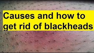 Blackheads: causes, treatment and prevention
