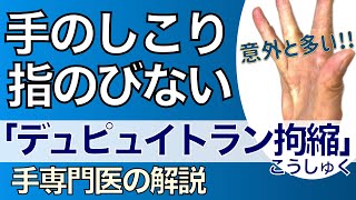 手のしこり、指が伸びない　「デュピュイトラン拘縮」という病気について