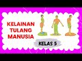 Kelainan Pada Tulang Manusia kelas 5