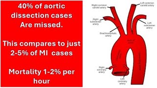 Emergency medicine Practical tips - Aortic dissection, a clinical approach to rule in/out.