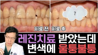 치경부 레진치료 받았는데 변색되고 울퉁불퉁해요😭 레진치료는 쉬운 치료?🤔 레진치료 받은 치아 오래오래 쓰려면❓