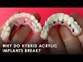 Why Do Hybrid Acrylic Implants Break?