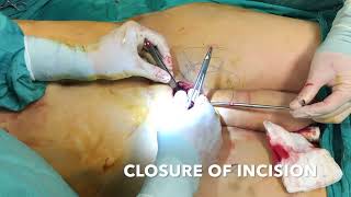 ZSI 100 FTM - Implant insertion by Dr. Serda Nasir, Turquey