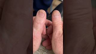 Unbelievable TOE TRANSPLANT!! 😳🤯 #shorts
