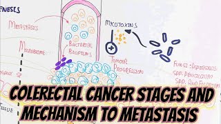 Colon Cancer Pathogenesis,Stages,Mechanism @umerfarooqbiology7083