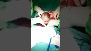 c-section##cesarean##short video##new baby birth.