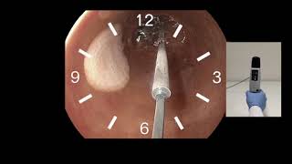 C2 CryoBalloon (First Gen) Ablation Zones Controller Tutorial Video