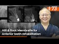 ARi & Root Membrane for Anterior teeth rehabilitation