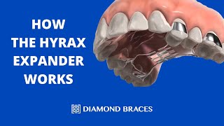 How The Hyrax Expander Works