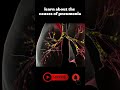 learn about the causes of pneumonia medical animation 3d short learn biology with aliya