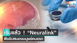 เริ่มแล้ว ! Neuralink ของอีลอน มัสก์ ฝังชิปกับสมองมนุษย์คนแรก | TNN Tech Reports