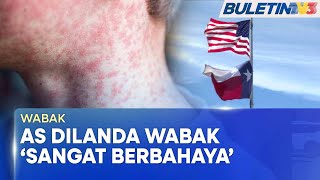 WABAK |  Tolak Vaksin, Punca Penularan Wabak Campak Di AS