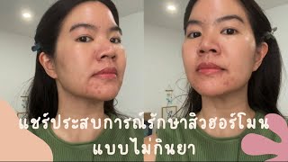 แชร์ประสบการณ์รักษาสิวฮอร์โมนแบบไม่กินยา update