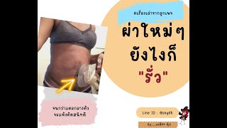 ผ่าทวารเทียมใหม่ๆ  ยังไงก็รั่ว By เภสัชฯ นุ้ย