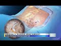 CBS 42 Highlights Arthrex's Ultra-Minimally Invasive Spine Surgery Techniques