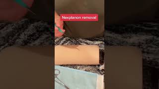 Nexplanon Birth Control Removal