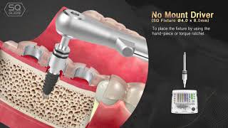 DENTIS DIGITAL GUIDE SYSTEM for SQ Implant, SQ GUIDE