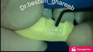 Teeth fracture filling, layering technique teeth,جوانکاری ددانی شکاو