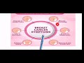 calamadaha lagu garto kansarka naasaha symptoms of breast cancer ...