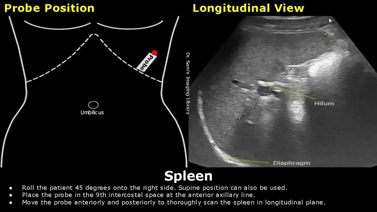 How To Scan The Spleen On Ultrasound | Probe Positioning | Transducer ...