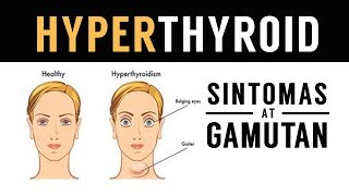 HYPERTHYROID: Sintomas at Gamutan - ni Dr Willie Ong #108b