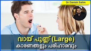 527: വായ് പുണ്ണ് കാരണങ്ങളും പരിഹരങ്ങളും||What is Aphthous Ulcer? What are the Causes and Treatment?