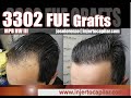 3302FUE Grafts. NW III. Restoration and repair due to hematoma. Injertocapilar.com.2176/2018